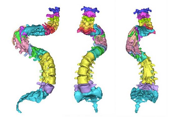 患者の背骨のカラフルな3Dモデルの3つの視点
