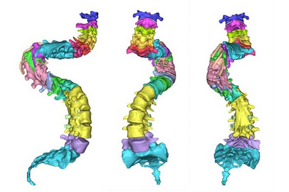 Three perspectives of a colorful 3D model of the patient's spine