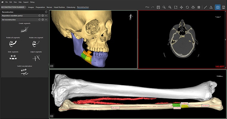 Screenshot of the reconstruction planner in Mimics Enlight CMF with segmented images of a patient's skull and fibula