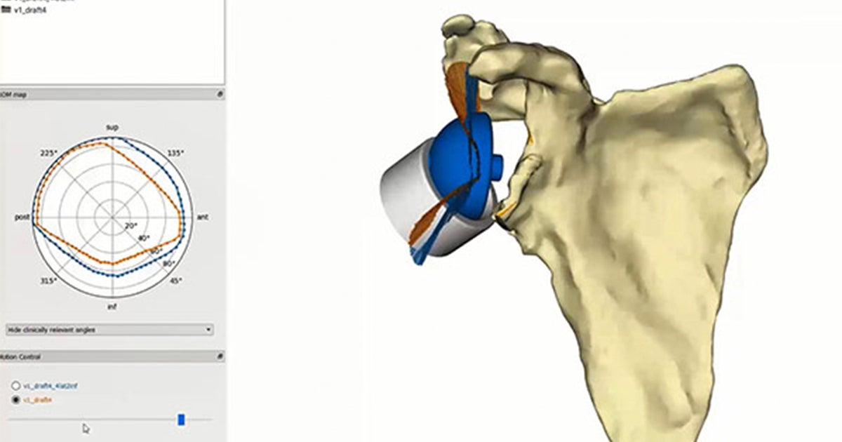 Planning a Glenius Personalized Shoulder Implant with the Clinical Engineer