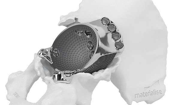 Personalized aMace hip implant shown in a hip bone model
