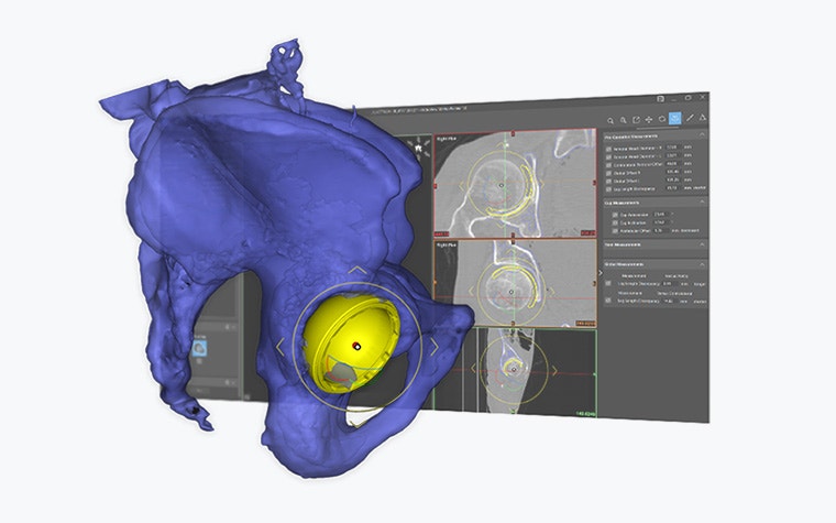 materialise-orthoview-3d-hip.jpg