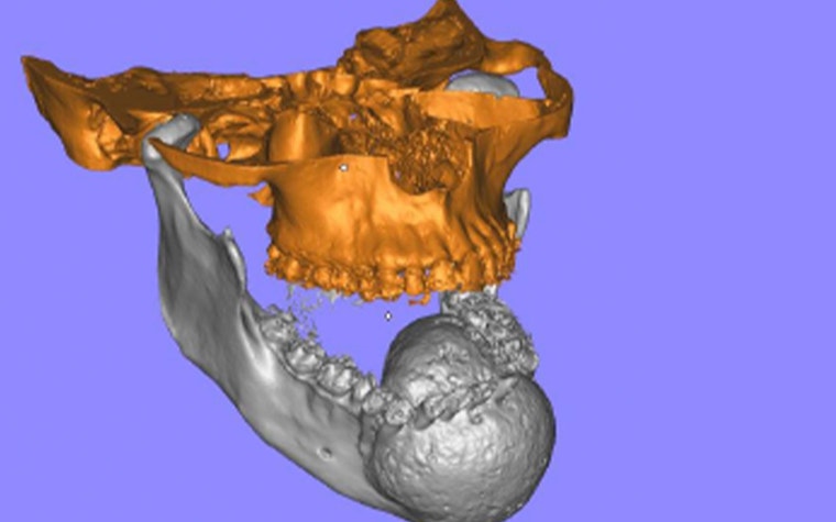 3D model of the patient's jaw in medical software