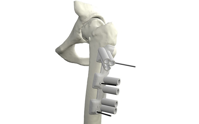 materialise-osteotomies-solutions-3d-printed-guides-indication-hip-model.jpg
