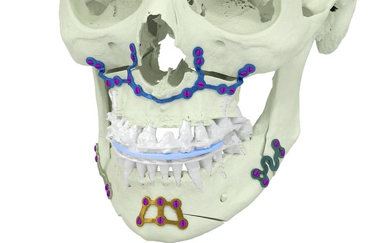 Personalized orthognathic plates from Materialise.  