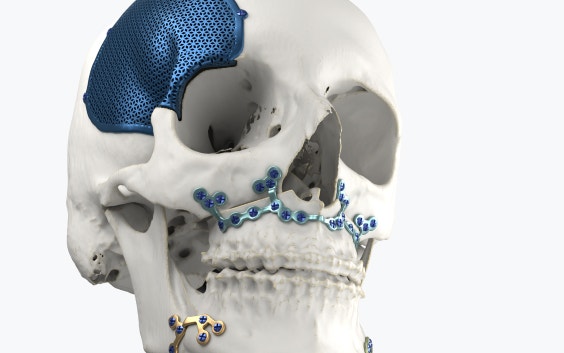Modèle de crâne avec des implants imprimés en 3D fixés