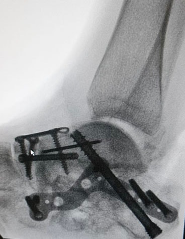X-ray of a foot/ankle with screws and a plate implanted
