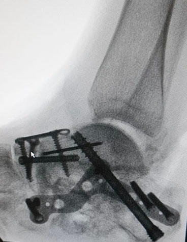 ankle-xray-screws-plate.jpg