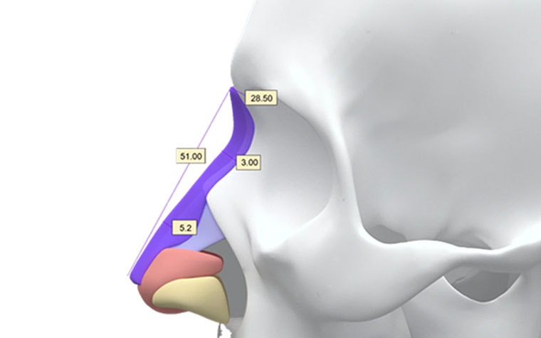 Side view of a digital model of a skull with measurements on the nose