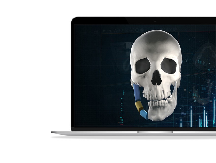Digital image of a skull with the right side of the jaw segmented shown in a laptop screen