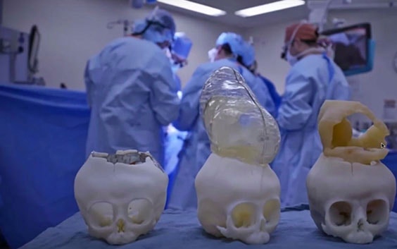 Three anatomical models of a baby's skull with the brain outside in an operating room with a group of surgeons in the background