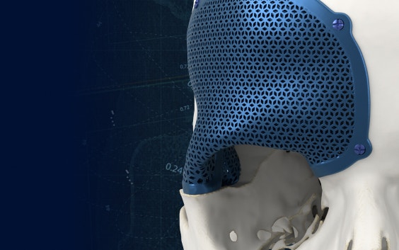 Vista en primer plano de un implante CMF poroso de titanio impreso en 3D