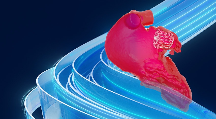 LAAO shown in a cutaway anatomy of a heart with a blue Mimics swirl background.