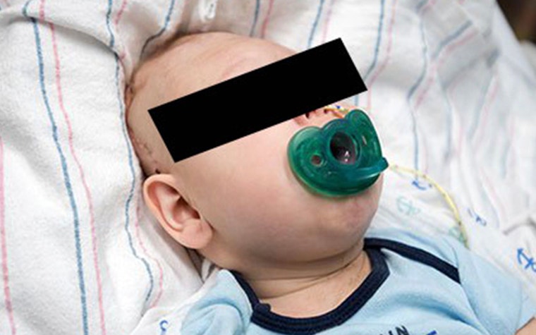 Image of baby after surgery 