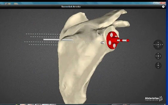 The Future in Shoulder Replacement Surgery: The Integration of 3D Planning and Guides in the Clinical Workflow