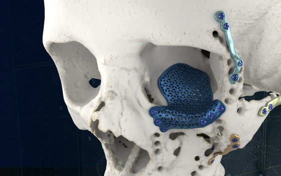 Modelo de cráneo con varios implantes CMF impresos en 3D colocados