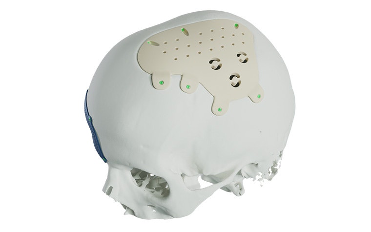 A skull with a PEEK implant fixated on it.