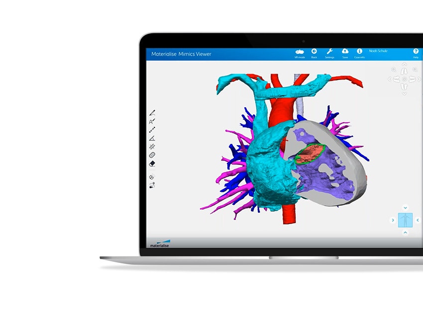 ssd-materialise-mimics-core-3d-segmented-heart-model.jpg