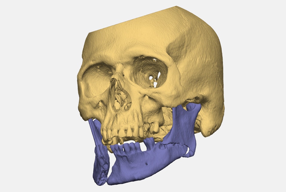 3D rendering of a human skull with the cranium highlighted in yellow and the broken mandible highlighted in blue.