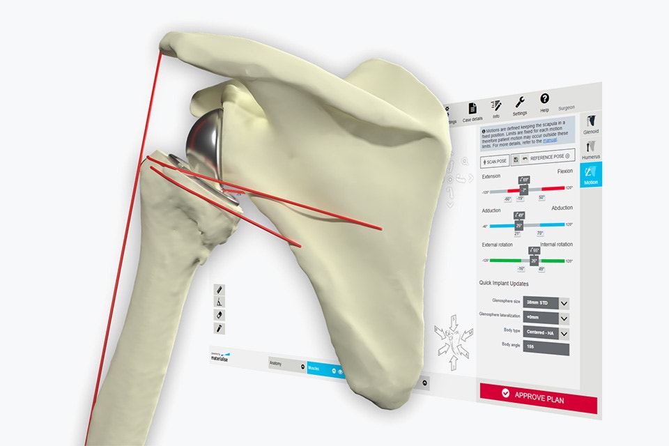 Digital image of a shoulder bone with red measurement lines in front of a computer screen