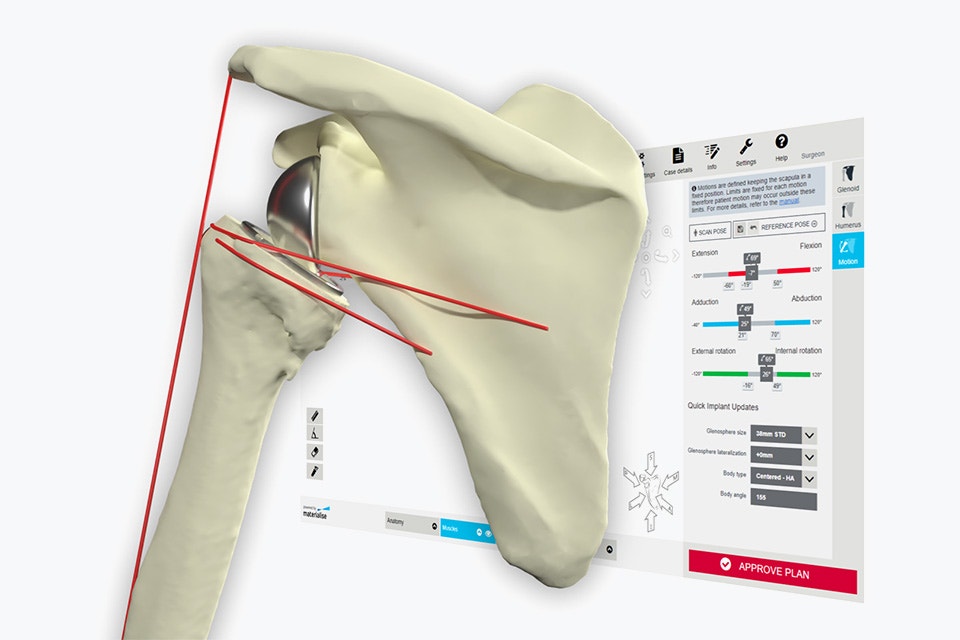 Imagen digital de un hueso del hombro con líneas de medición rojas delante de una pantalla de ordenador