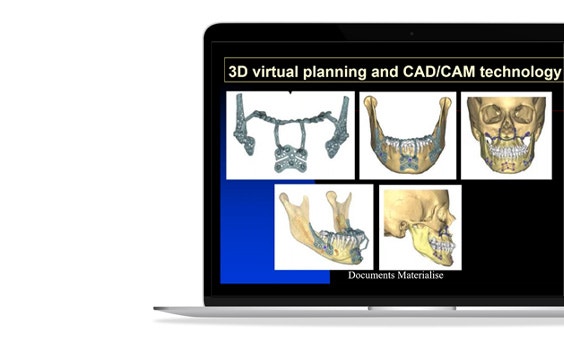 ssm-3d-planning-cad-cam-technology-skulls-s-plate.jpg