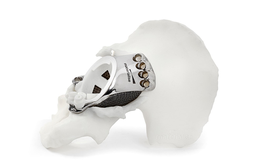 Implante metálico aMace impreso en 3D en un modelo de cadera