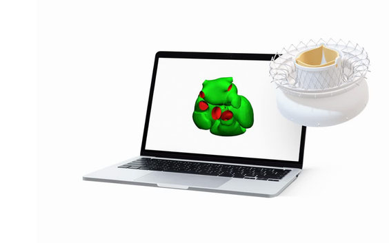 A laptop displaying a green 3D anatomical heart model with highlighted red regions beside a 3D-rendered heart valve implant on a white background.