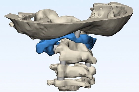 Render of the anatomical model of Jalanea’s spine and skull