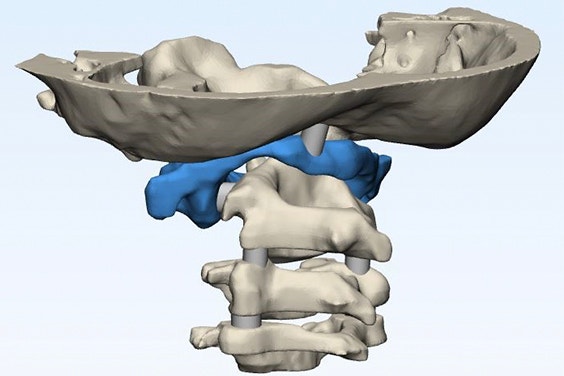 Render of the anatomical model of Jalanea’s spine and skull 