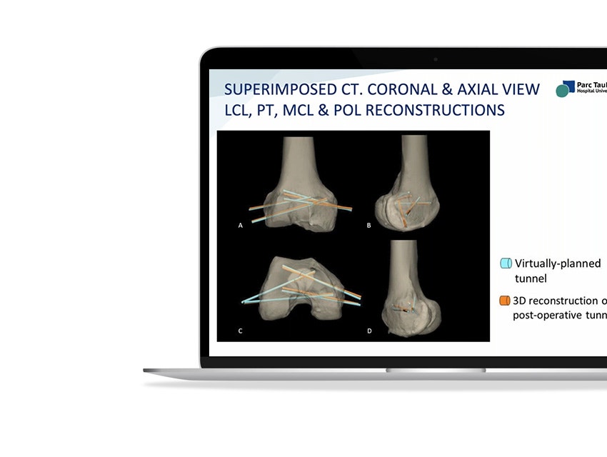 A laptop with a presentation on screen, showing superimposed CT. coronal & axial view LCL, PT, MCL, and POL reconstructions