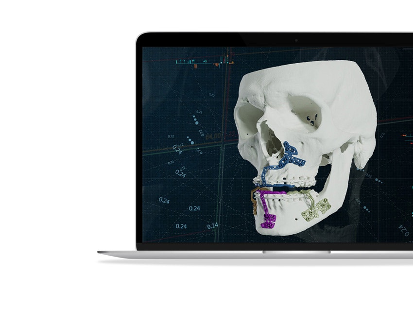 ssd-materialise-cmf-solutions-3d-printed-guides-skull-mios.jpg