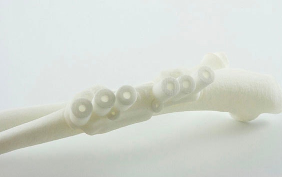3D-gedruckte chirurgische Schablone
