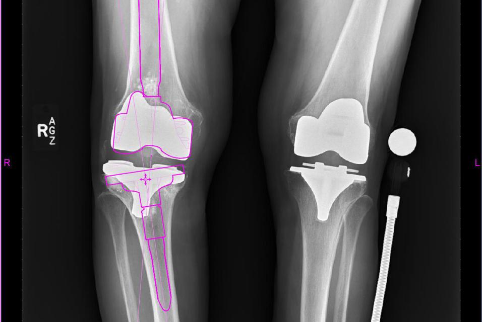 X-ray of a patient's knees