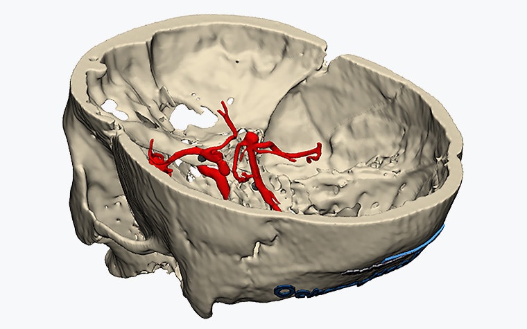 3D-rendered partial skull model with red-highlighted brain blood vessels visible inside.