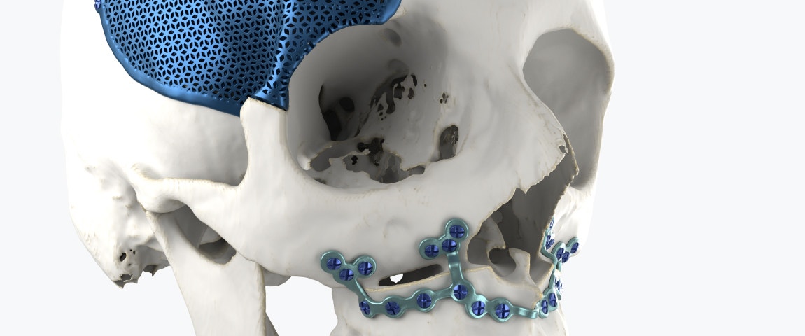 Skull model with 3D-printed implants attached