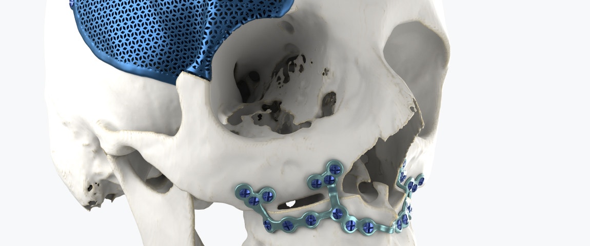 Modèle de crâne avec des implants imprimés en 3D fixés