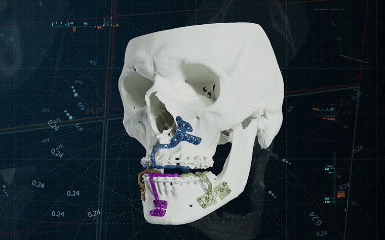 materialise-cmf-solutions-3d-printed-guides-skull-mios.jpg