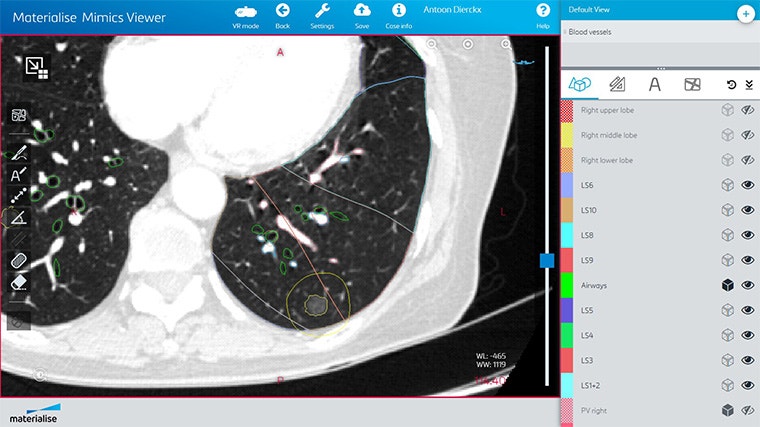 Screenshot of Mimics Viewer showing a view for CT scans that are not contrast-enhanced