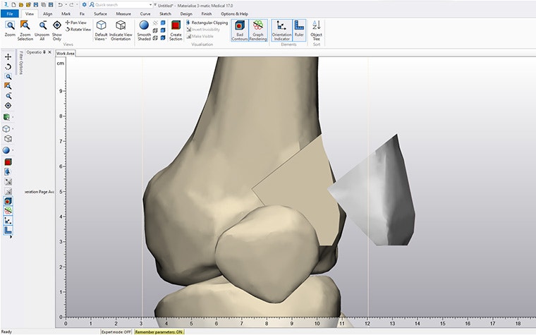 Screenshot of Materialise 3-matic software with a bone model and a separate implant that fits perfectly into the bone.