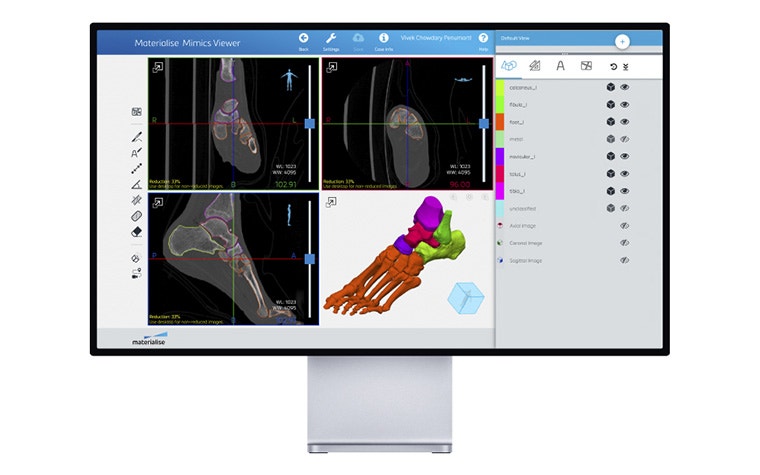Computer screen with Mimics Viewer showing a patient's foot scans and a 3D model of the foot bones