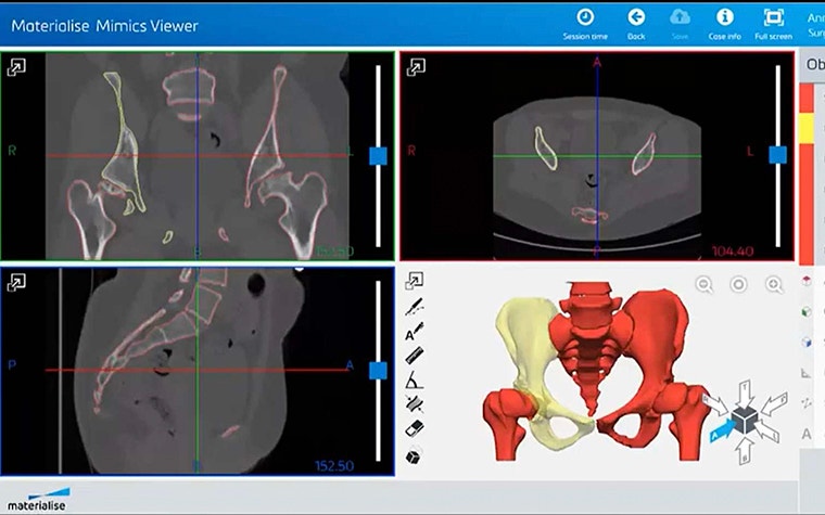 Capture d'écran de Materialise Mimics Viewer montrant des images de bassin humain