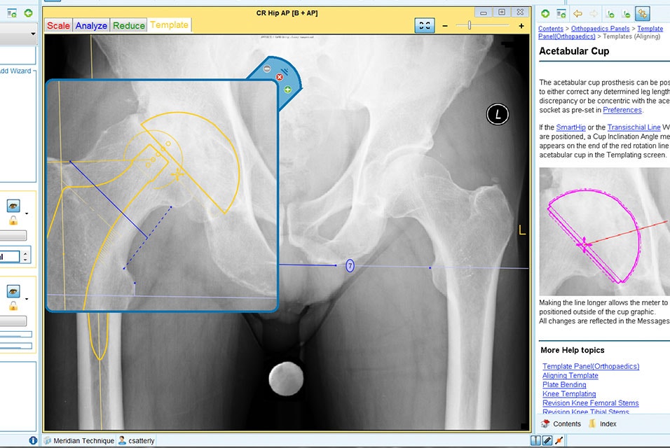 View of a pelvis X-ray in OrthoView software