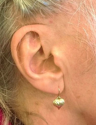 The patient’s ear.