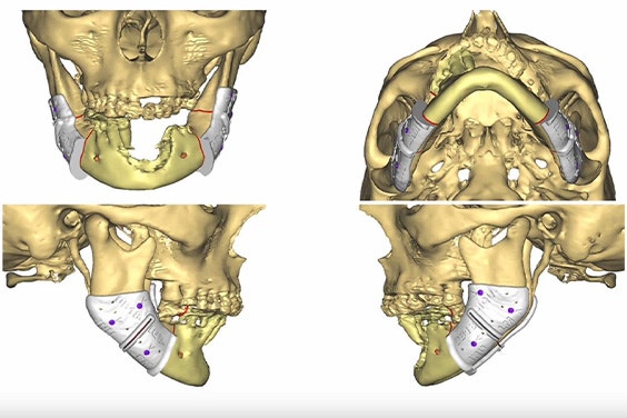 Four angles showing a 3D model of a patient's skull with personalized, 3D-printable cutting guides attached to the mandible