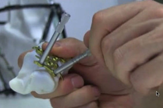 Hands holding a surgical guide on bone model