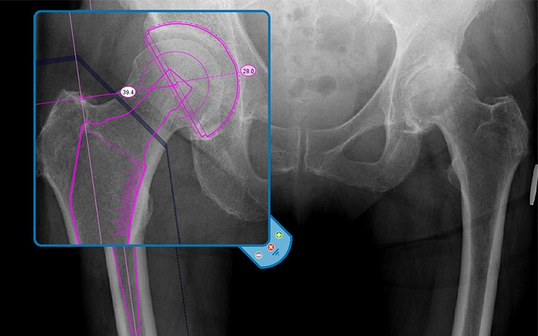 X-ray of a patient's hips with a zoomed-in overlay of a hip implant and measurements