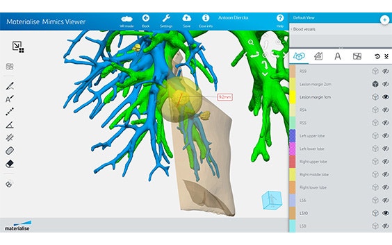 Digital 3D model of a patient's airways in the Materialise Mimics Planner software