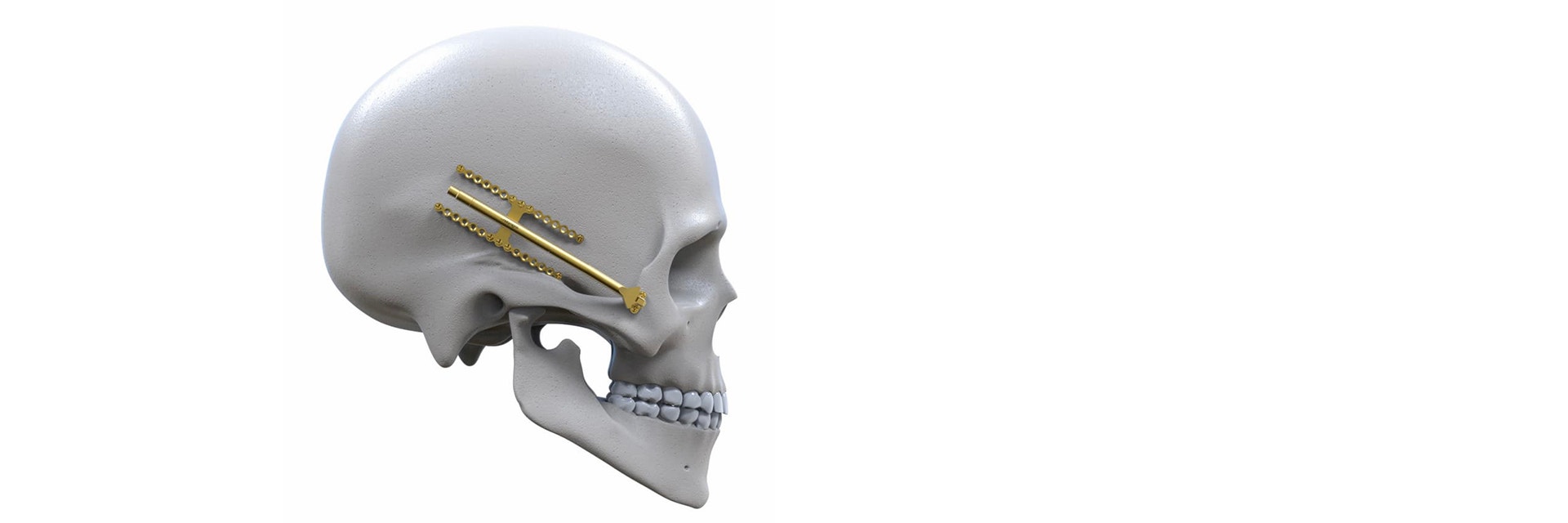 Engimplan implants in the skull