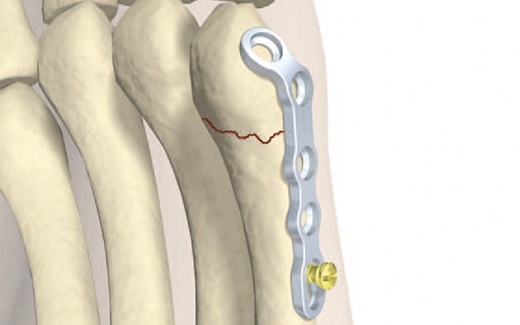 Redesigned metacarpal plate shown vertically on computer-generated image 